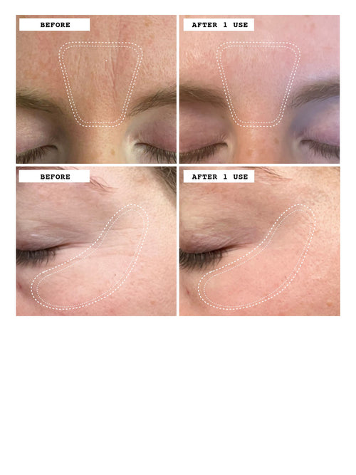 Wrinkle Erasing Retinol Patches